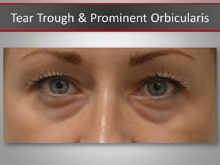 Tear Trough & Prominent Orbicularis
 