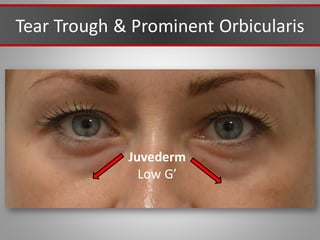 Tear Trough & Prominent Orbicularis
Juvederm
Low G’
 