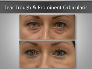 Tear Trough & Prominent Orbicularis
 