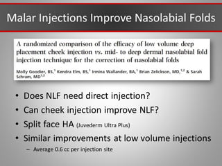Malar Injections Improve Nasolabial Folds
• Does NLF need direct injection?
• Can cheek injection improve NLF?
• Split face HA (Juvederm Ultra Plus)
• Similar improvements at low volume injections
– Average 0.6 cc per injection site
 