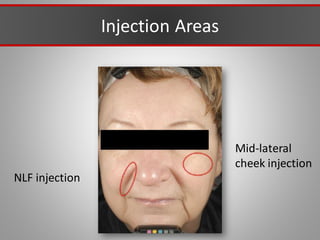 Injection Areas
NLF injection
Mid-lateral
cheek injection
 