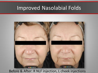 Improved Nasolabial Folds
Before & After: R NLF injection, L cheek injections
 