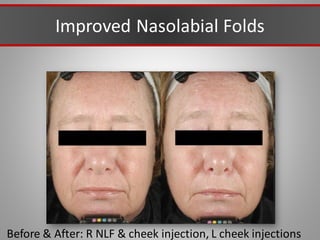 Improved Nasolabial Folds
Before & After: R NLF & cheek injection, L cheek injections
 