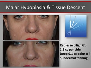 Malar Hypoplasia & Tissue Descent
Radiesse (High G’)
1.5 cc per side
Deep 0.1 cc bolus x 4
Subdermal fanning
 