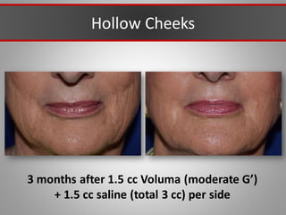 Hollow Cheeks
3 months after 1.5 cc Voluma (moderate G’)
+ 1.5 cc saline (total 3 cc) per side
 