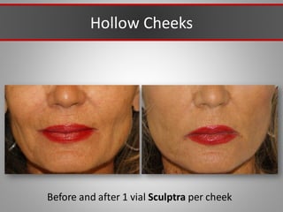 Hollow Cheeks
Before and after 1 vial Sculptra per cheek
 