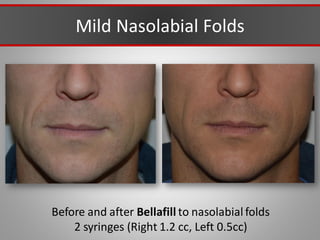 Mild Nasolabial Folds
Before and after Bellafill to nasolabial folds
2 syringes (Right 1.2 cc, Left 0.5cc)
 