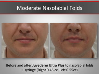 Before and after Juvederm Ultra Plus to nasolabial folds
1 syringe (Right 0.45 cc, Left 0.55cc)
Moderate Nasolabial Folds
 