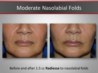Moderate Nasolabial Folds
Before and after 1.5 cc Radiesse to nasolabial folds
 