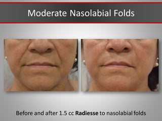 Moderate Nasolabial Folds
Before and after 1.5 cc Radiesse to nasolabial folds
 