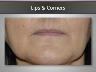 Lips & Corners
 