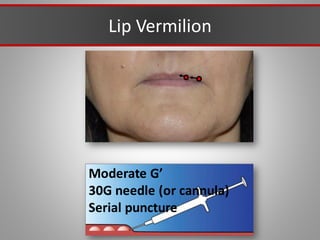 Lip Vermilion
Moderate G’
30G needle (or cannula)
Serial puncture
 
