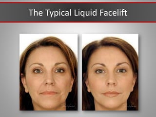 The Typical Liquid Facelift
 