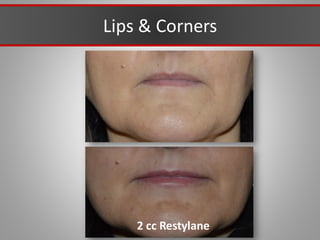 Lips & Corners
2 cc Restylane
 