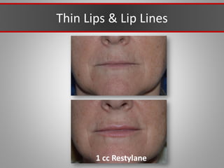 Thin Lips & Lip Lines
1 cc Restylane
 