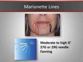 Marionette Lines
Moderate to high G’
27G or 29G needle
Fanning
 