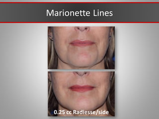 Marionette Lines
0.25 cc Radiesse/side
 
