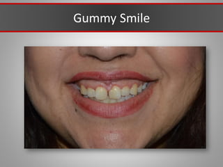Gummy Smile
 