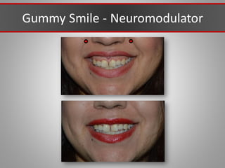 Gummy Smile - Neuromodulator
 
