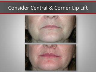 Consider Central & Corner Lip Lift
 