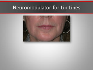 Neuromodulator for Lip Lines
 