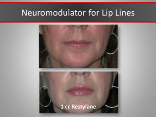 Neuromodulator for Lip Lines
1 cc Restylane
 