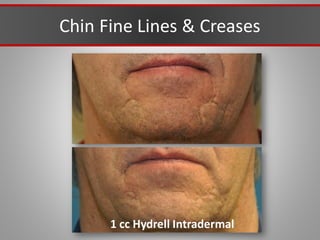 Chin Fine Lines & Creases
1 cc Hydrell Intradermal
 