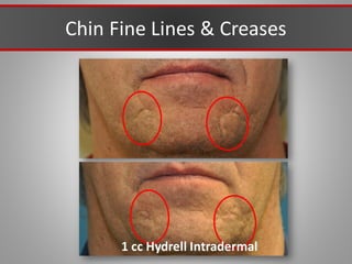 Chin Fine Lines & Creases
1 cc Hydrell Intradermal
 