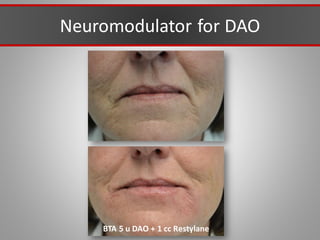 Neuromodulator for DAO
BTA 5 u DAO + 1 cc Restylane
 