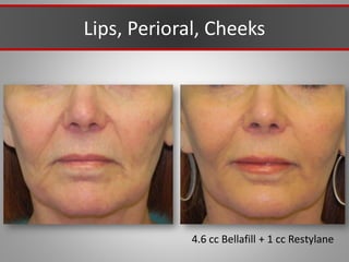 Lips, Perioral, Cheeks
4.6 cc Bellafill + 1 cc Restylane
 