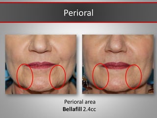Perioral area
Bellafill 2.4cc
Perioral
 