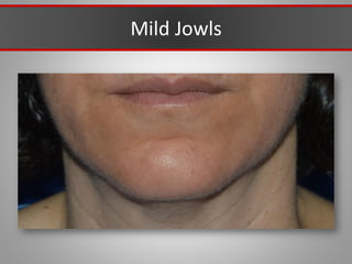 Mild Jowls
 