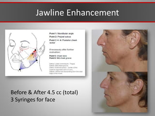 Jawline Enhancement
Before & After 4.5 cc (total)
3 Syringes for face
 
