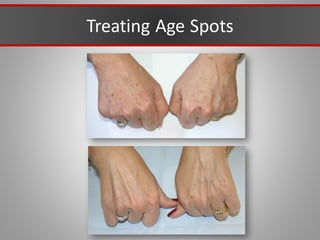 Treating Age Spots
 