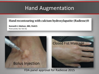 Hand Augmentation
FDA panel approval for Radiesse 2015
Bolus Injection
Closed Fist Massage
 