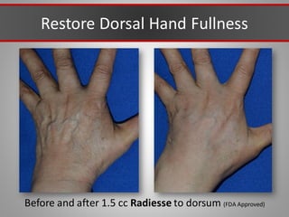 Restore Dorsal Hand Fullness
Before and after 1.5 cc Radiesse to dorsum (FDA Approved)
 