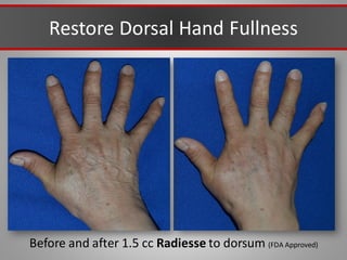 Restore Dorsal Hand Fullness
Before and after 1.5 cc Radiesse to dorsum (FDA Approved)
 