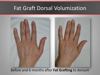 Fat Graft Dorsal Volumization
Before and 6 months after Fat Grafting to dorsum
 