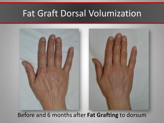Fat Graft Dorsal Volumization
Before and 6 months after Fat Grafting to dorsum
 