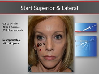 Start Superior & Lateral
0.8 cc syringe
40 to 50 passes
27G blunt cannula
Supraperiosteal
Microdroplets
 