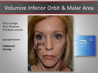 Volumize Inferior Orbit & Malar Area
0.8 cc syringe
40 to 50 passes
27G blunt cannula
Supraperiosteal
Subdermal
Fanning
 