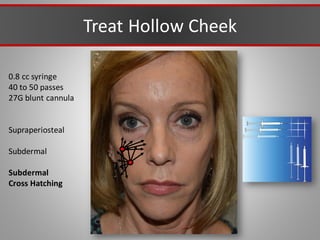 Treat Hollow Cheek
0.8 cc syringe
40 to 50 passes
27G blunt cannula
Supraperiosteal
Subdermal
Subdermal
Cross Hatching
 