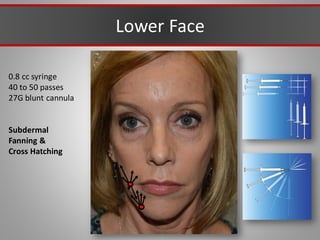 0.8 cc syringe
40 to 50 passes
27G blunt cannula
Subdermal
Fanning &
Cross Hatching
Lower Face
 