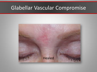 Glabellar Vascular Compromise
Healed
 