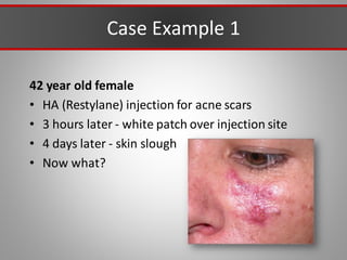 Case Example 1
42 year old female
• HA (Restylane) injection for acne scars
• 3 hours later - white patch over injection site
• 4 days later - skin slough
• Now what?
 