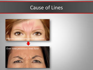 Cause of Lines
Muscle contractions cause skin folds
Over time persistent lines form
 