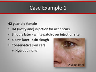 Case Example 1
42 year old female
• HA (Restylane) injection for acne scars
• 3 hours later - white patch over injection site
• 4 days later - skin slough
• Conservative skin care
+ Hydroquinone
2 years later
 