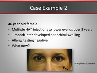 Case Example 2
46 year old female
• Multiple HA* injections to lower eyelids over 3 years
• 1 month later developed periorbital swelling
• Allergy testing negative
• What now?
* Restylane & Juvederm
 