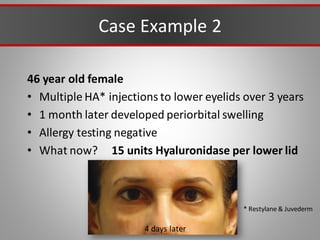 Case Example 2
46 year old female
• Multiple HA* injections to lower eyelids over 3 years
• 1 month later developed periorbital swelling
• Allergy testing negative
• What now? 15 units Hyaluronidase per lower lid
4 days later
* Restylane & Juvederm
 