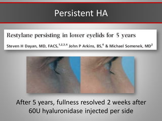 Persistent HA
After 5 years, fullness resolved 2 weeks after
60U hyaluronidase injected per side
 